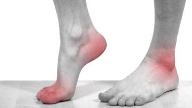 أسباب مرض النقرس وأعراضه 8 أسباب مرض النقرس وأعراضه